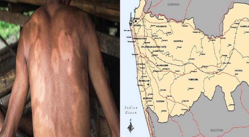 கொழும்பில் அதிகரித்து வரும் தொழுநோயாளர்கள்!