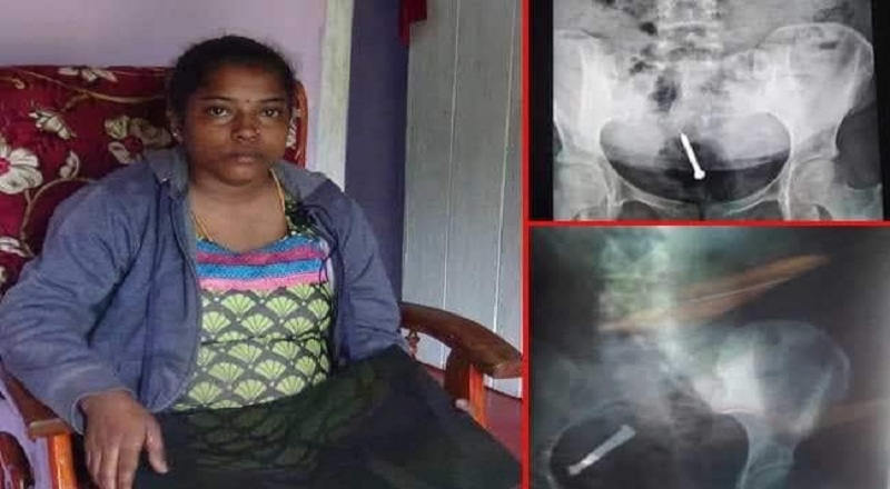 சவுதிக்கு பணிக்கு சென்ற பெண்ணுக்கு நேர்ந்த துயரம் : உணவுக்கு பதில் ஆணியை சாப்பிட வைத்த முதலாளி!