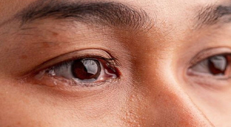கான்ஜுன்க்டிவிடிஸ்’ எனப்படும் கண் தொற்று குறித்து சுகாதார அதிகாரிகள் எச்சரிக்கை!