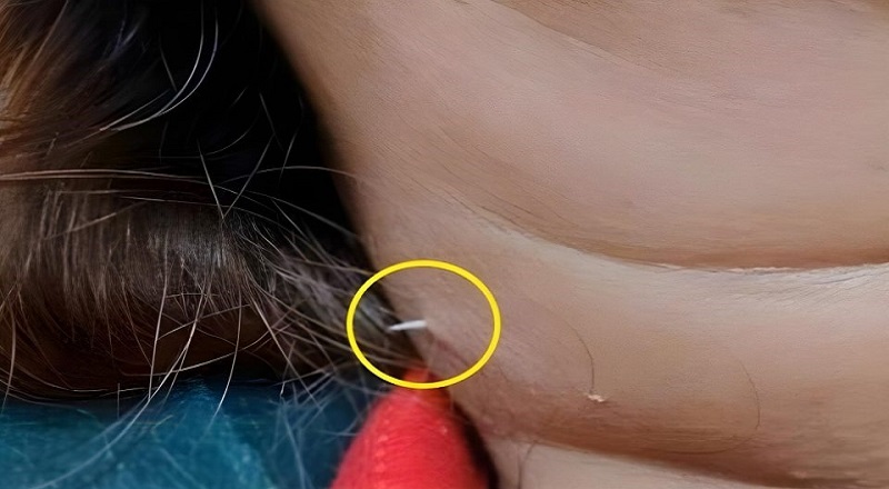 தாய்லாந்தில் மீன்சாப்பிட்ட ஒருவருக்கு நேர்ந்த துயரம்!
