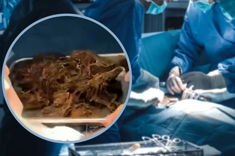 15 வயது சிறுமியின் வயிற்றில் இருந்து அகற்றப்பட்ட 2 கிலோ முடி