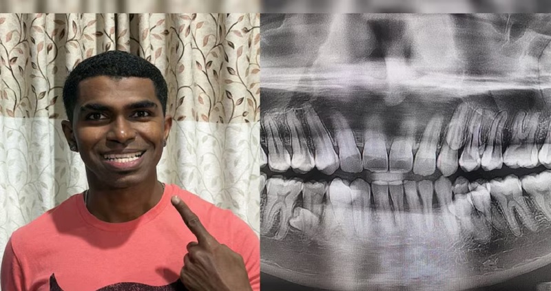 அதிக பற்கள் கொண்டு உலக சாதனை படைத்த மலேசிய நபர்