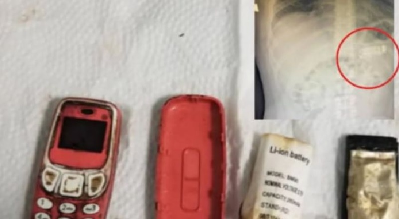 வயிற்றுக்குள் அலாரம்! அதிர்ச்சி அடைந்த மருத்துவர்கள்! 