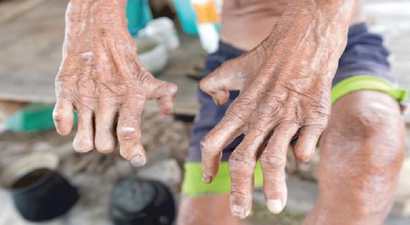 இந்த வருடத்தில் மொரட்டுவ பிரதேசத்தில் அதிகளவான தொழுநோயாளிகள் பதிவு