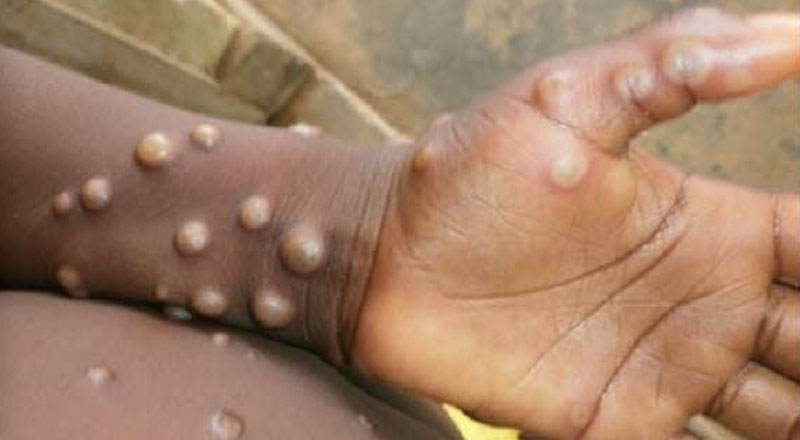 வெளிநாட்டில் இருந்து நாடு திரும்பிய இருவருக்கு குரங்கம்மை நோய் கண்டுபிடிப்பு!