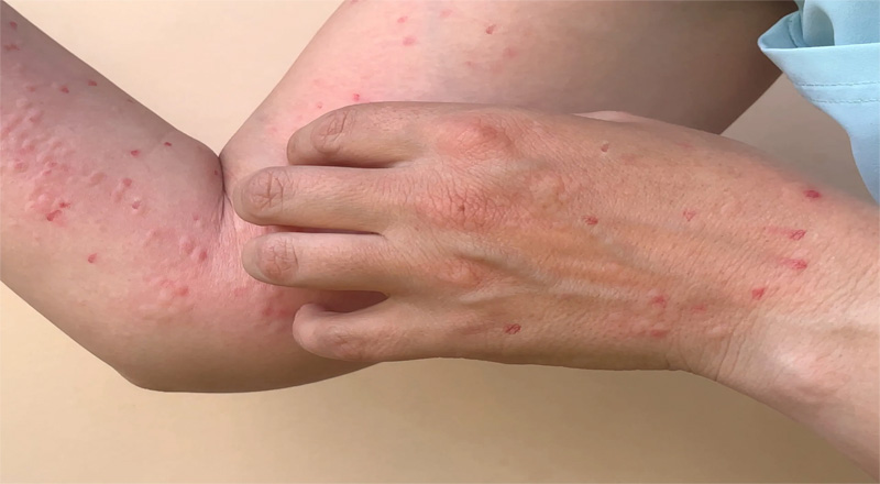 இலங்கையில் பரவியுள்ள குரங்கம்மை நோய் மேலும் பரவும் சாத்தியமில்லை - Dr.Samitha Ginige