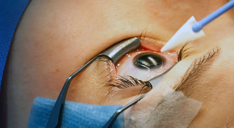 கண் சத்திரசிகிச்சைக்கு உட்படுத்தப்பட்ட பின் பார்வையிழந்துள்ள நோயாளர்கள் : மனித உரிமைகள் ஆணைக்குழுவில் முறைப்பாடு