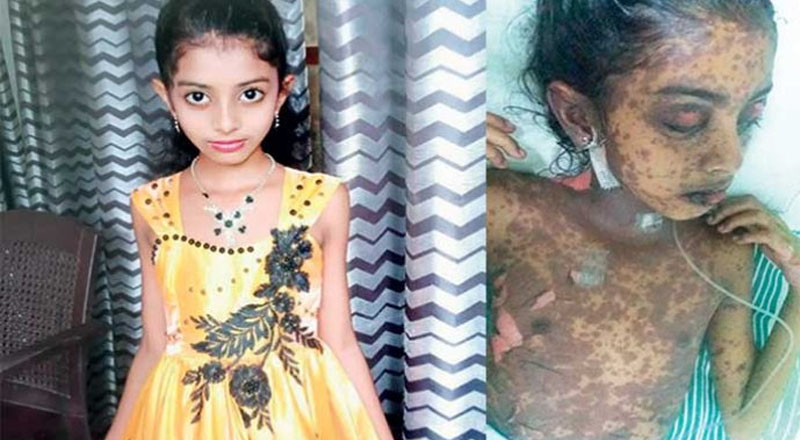 இரத்தினபுரியில் காய்ச்சலுக்கு சிகிச்சை பெற்று கண்பார்வை இழந்த சிறுமி