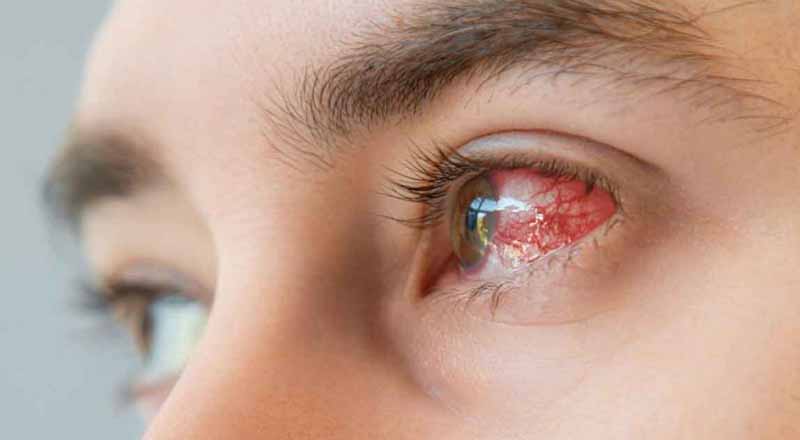 நாட்டில் பரவி வரும் கண் நோய் தொடர்பில் விடுக்கப்பட்டுள்ள அறிவுறுத்தல்!