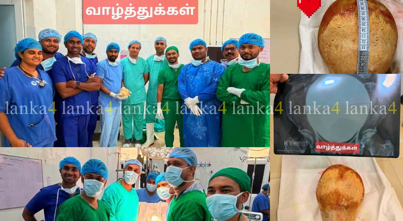 திருகோணமலை பொது வைத்தியசாலையில் 3.1 கிலோ சிறுநீரகக் கல் அகற்றப்பட்டதாக தகவல்!