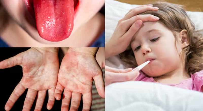 பிரித்தானியாவில் திடீரென்று Strep A பரவல் அதிகரிப்பு-ஸ்தம்பிக்கும் மருத்துவமனை அவசரப்பிரிவு